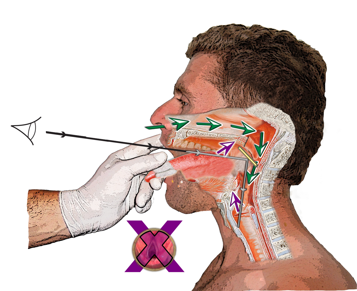 HOW WE DO IT AN IMPROVED TECHNIQUE OF INDIRECT LARYNGOSCOPY